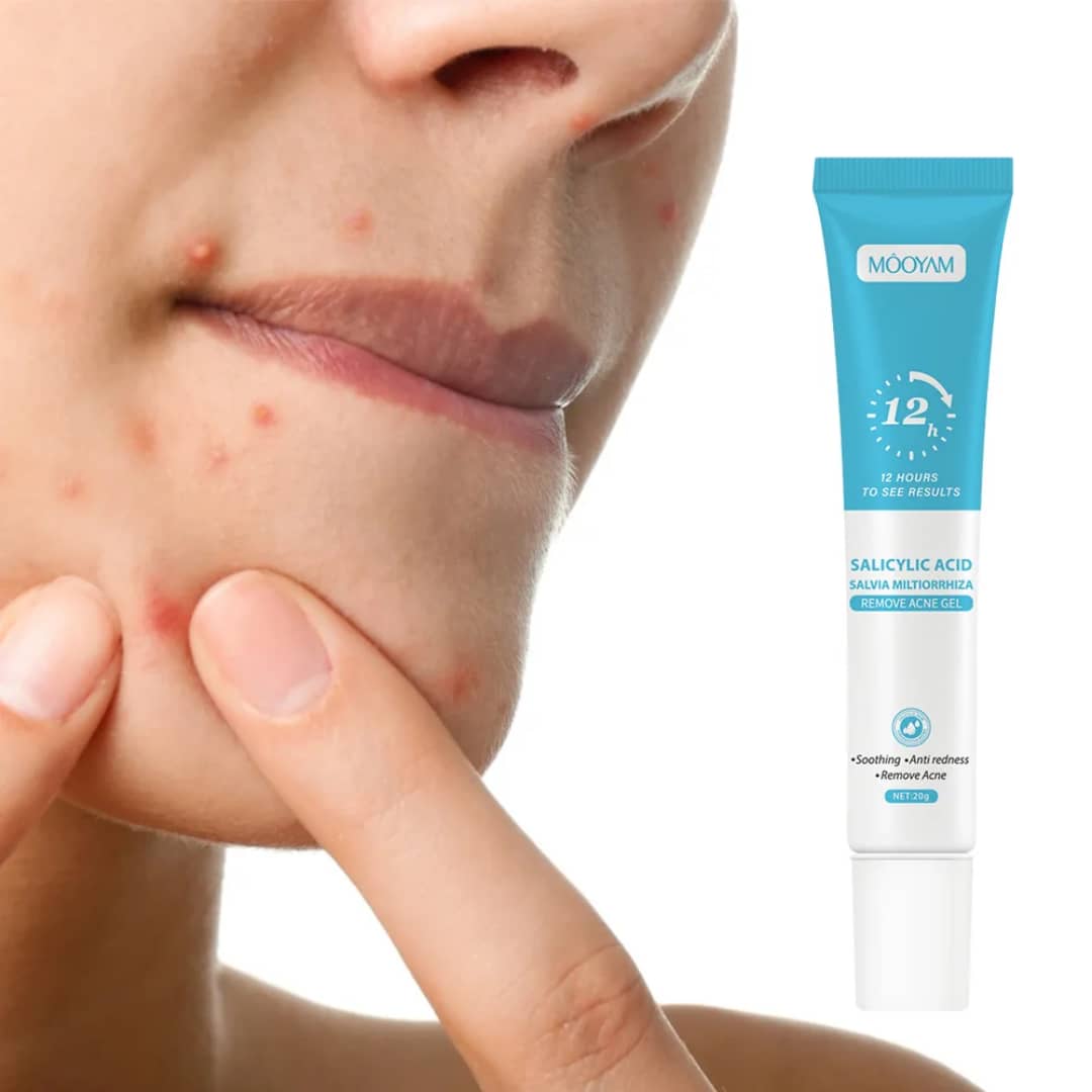 Gel anti-acné - vue 1 - Sylite Boutique
